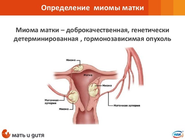 Миома Матки И Беременность Реферат 2022 Миома Матки И Беременность Реферат 2022